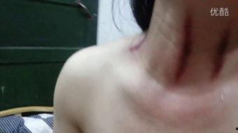 揪脖子痧视频,轻松缓解颈部酸痛的神奇疗法